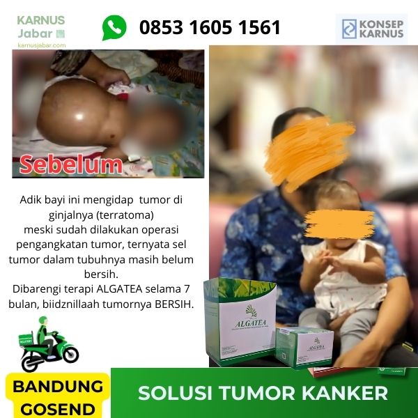 Nutrisi Penanganan Sel Abnormal - Tumor Kanker Autoimun Lupus - Image 2
